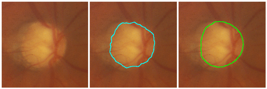 segmented optic nerve head